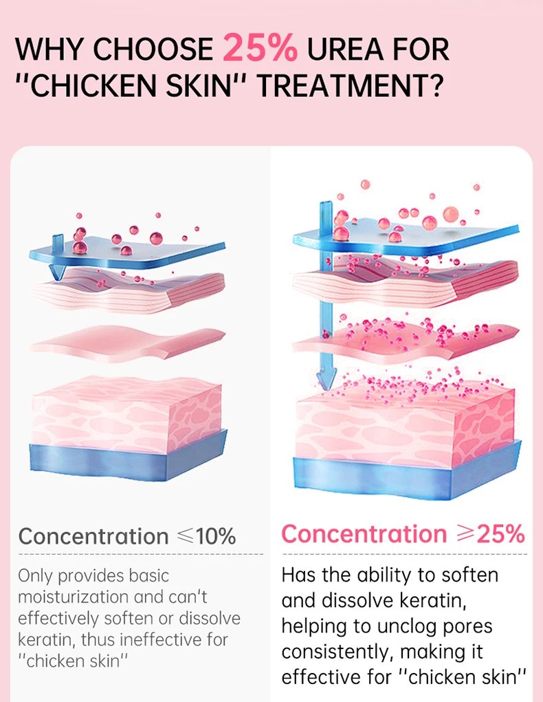 Keratosis Pilaris Lotion Rough Bumpy Pore Spots