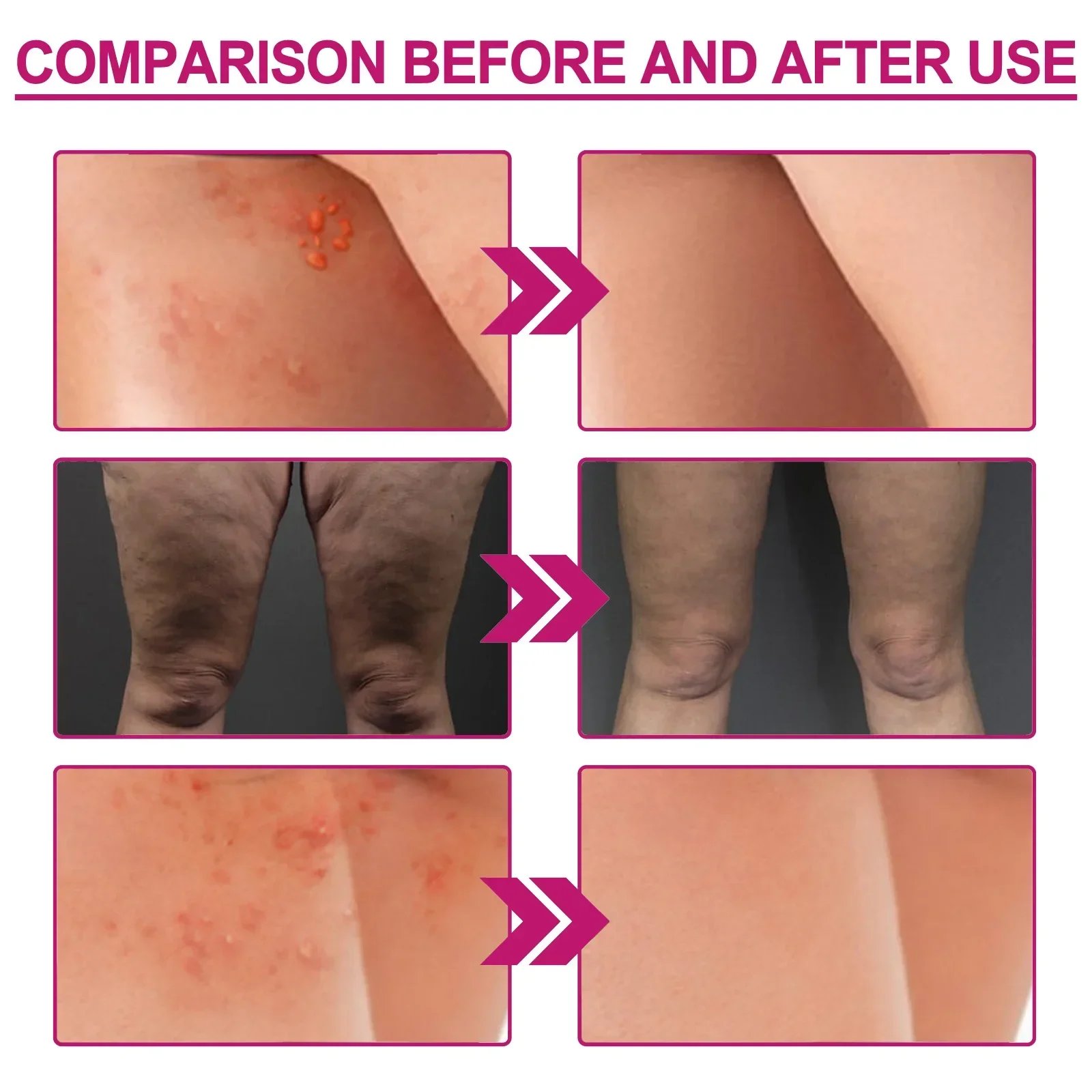 Fade Pimples Moisturize Lotion Butt Inner Thigh Fade Pimples Moisturize Lotion Butt Inner Thigh