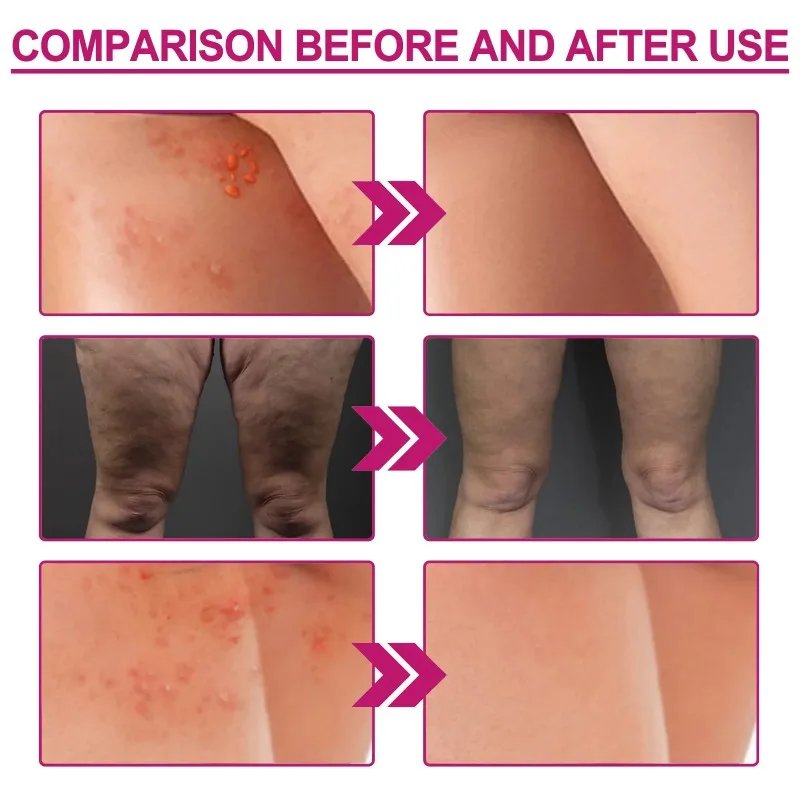 Fade Pimples Moisturize Lotion Butt Inner Thigh - Image 4