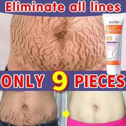 Stretch Marks Permanent Removal Cream