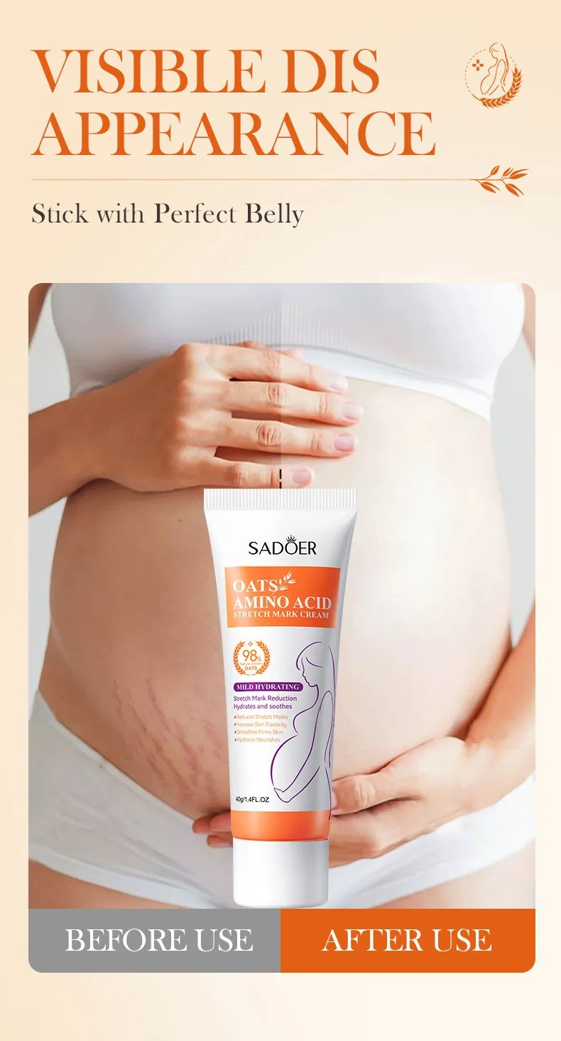 Stretch Marks Permanent Removal Cream