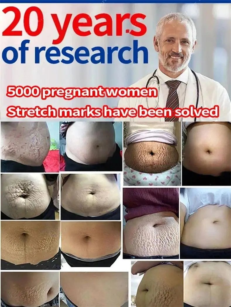 Stretch Marks Permanent Removal Cream