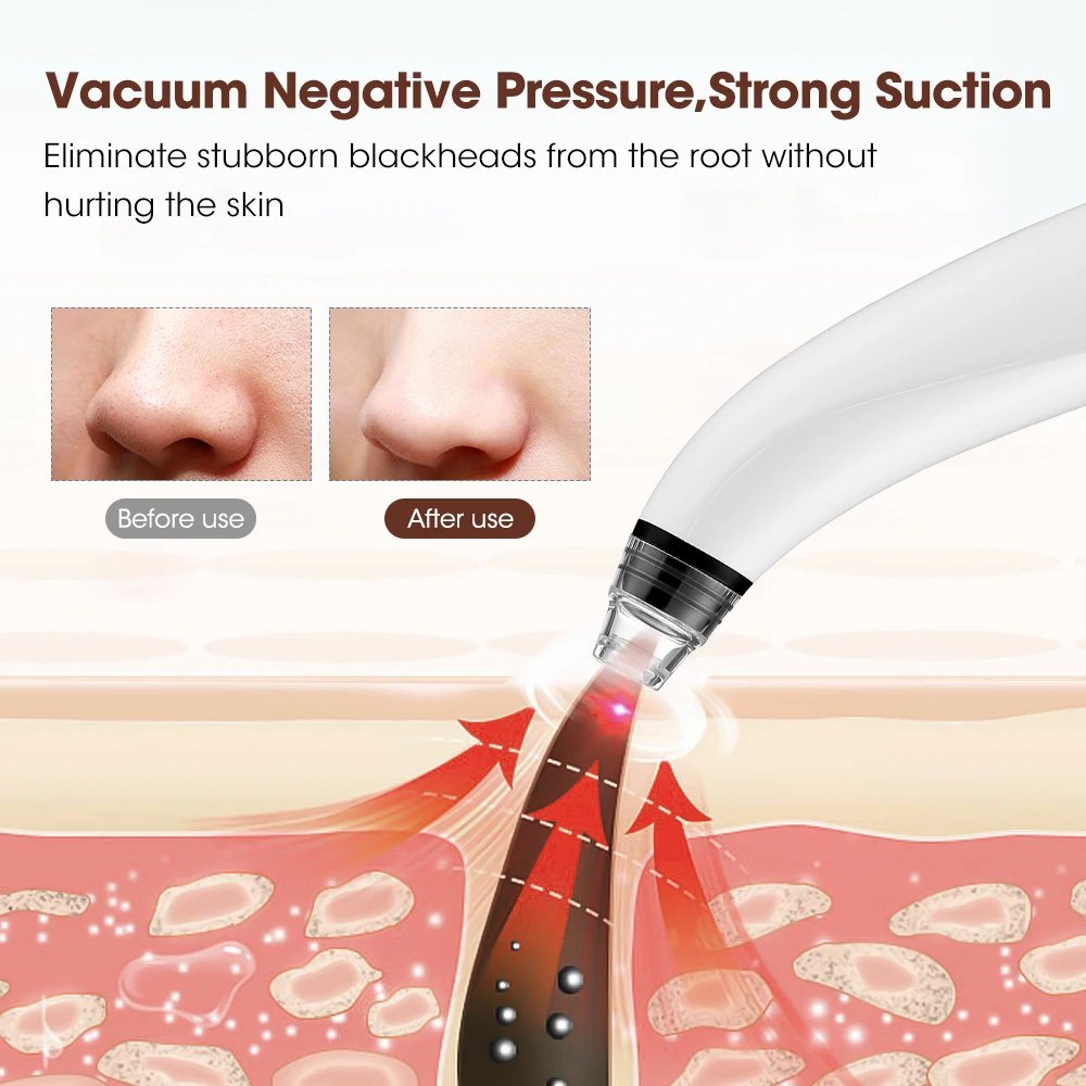 Wireless Camera Visual Blackhead Remover - Image 4