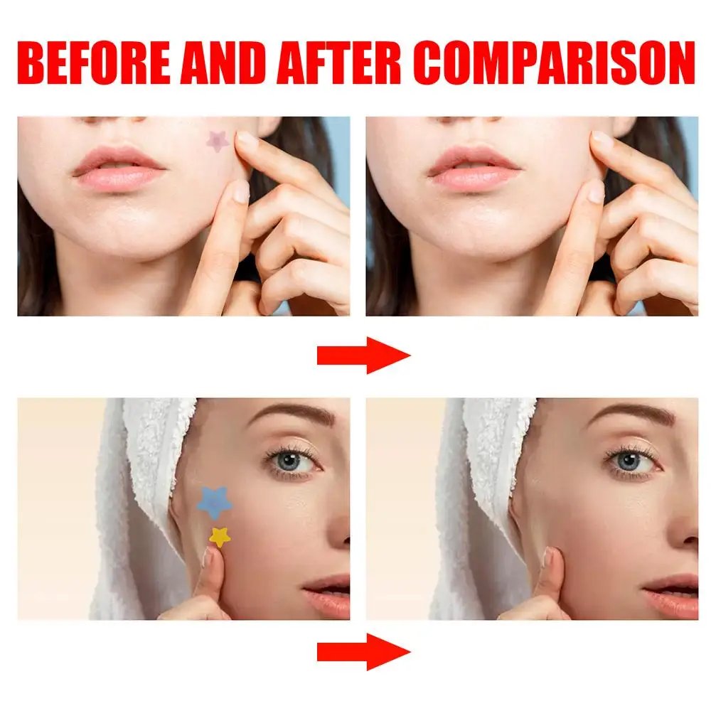 200pcs Star Shape Pimple Patches Colorful